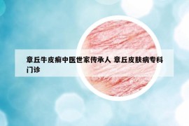 章丘牛皮癬中醫(yī)世家傳承人 章丘皮膚病?？崎T診