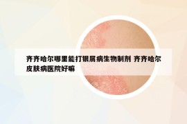 齊齊哈爾哪里能打銀屑病生物制劑 齊齊哈爾皮膚病醫(yī)院好嘛