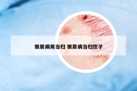 銀屑病用當(dāng)歸 銀屑病當(dāng)歸飲子