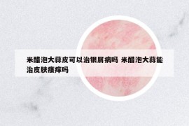 米醋泡大蒜皮可以治銀屑病嗎 米醋泡大蒜能治皮膚瘙癢嗎