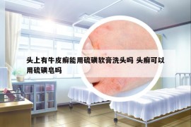 頭上有牛皮癬能用硫磺軟膏洗頭嗎 頭癬可以用硫磺皂嗎