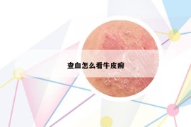 查血怎么看牛皮癬