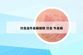 針灸治牛皮癬視頻 針灸 牛皮癬