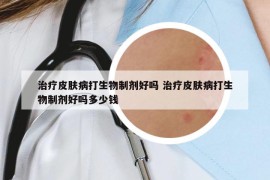 治療皮膚病打生物制劑好嗎 治療皮膚病打生物制劑好嗎多少錢