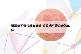 銀屑病不管將就會好嘛 銀屑病不管它會怎么樣