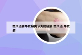類風(fēng)濕和牛皮癬關(guān)節(jié)炎的區(qū)別 類風(fēng)濕 牛皮癬