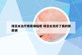 綠豆水治療銀屑病貼吧 綠豆水洗好了我的銀屑病