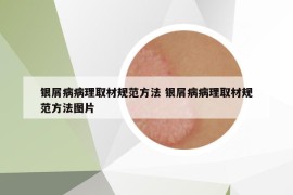 銀屑病病理取材規(guī)范方法 銀屑病病理取材規(guī)范方法圖片