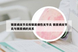 銀屑病關節(jié)炎和銀屑病性關節(jié)炎 銀屑病關節(jié)炎與銀屑病的關系