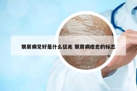銀屑病見好是什么征兆 銀屑病痊愈的標(biāo)志
