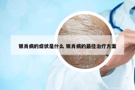 銀肖病的癥狀是什么 銀肖病的最佳治療方案