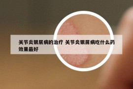 關(guān)節(jié)炎銀屑病的治療 關(guān)節(jié)炎銀屑病吃什么藥效果最好