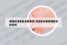 那里的溫泉能治銀屑病 泡溫泉治銀屑病能有好處嗎