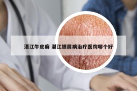 湛江牛皮癬 湛江銀屑病治療醫(yī)院哪個好