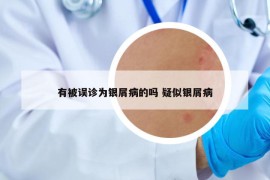 有被誤診為銀屑病的嗎 疑似銀屑病