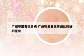 廣州哪里看銀屑病 廣州哪里看銀屑病比較好的醫(yī)院