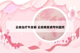 云南治療牛皮癬 云南銀屑病?？漆t(yī)院