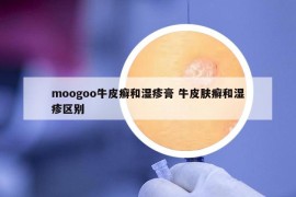 moogoo牛皮癬和濕疹膏 牛皮膚癬和濕疹區(qū)別