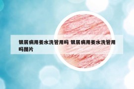 銀屑病用姜水洗管用嗎 銀屑病用姜水洗管用嗎圖片