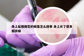 身上起圈圈型的癬是怎么回事 身上長了很多圈狀癬