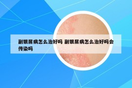 副銀屑病怎么治好嗎 副銀屑病怎么治好嗎會傳染嗎