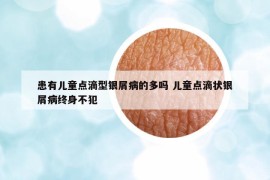 患有兒童點滴型銀屑病的多嗎 兒童點滴狀銀屑病終身不犯