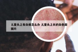 兒童頭上有白癬怎么辦 兒童頭上長的白色蘚圖片