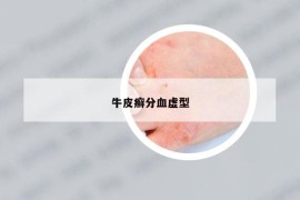 牛皮癬分血虛型