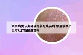 銀屑病關節(jié)炎可以打新冠疫苗嗎 銀屑病關節(jié)炎可以打新冠疫苗嗎