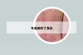 牛皮癬好了發(fā)白