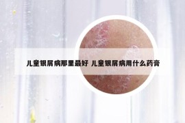 兒童銀屑病那里最好 兒童銀屑病用什么藥膏
