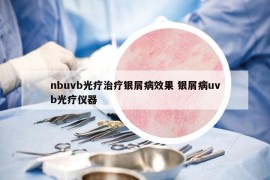 nbuvb光療治療銀屑病效果 銀屑病uvb光療儀器