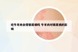 吃牛羊肉會(huì)得銀屑病嗎 牛羊肉對(duì)銀屑病的影響