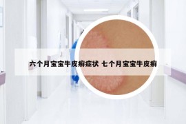 六個月寶寶牛皮癬癥狀 七個月寶寶牛皮癬