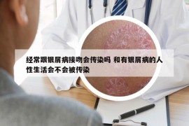 經(jīng)常跟銀屑病接吻會傳染嗎 和有銀屑病的人性生活會不會被傳染