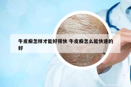 牛皮癬怎樣才能好得快 牛皮癬怎么能快速的好