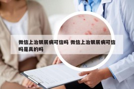 微信上治銀屑病可信嗎 微信上治銀屑病可信嗎是真的嗎