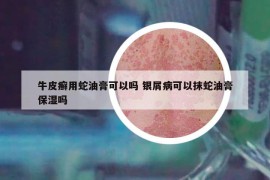 牛皮癬用蛇油膏可以嗎 銀屑病可以抹蛇油膏保濕嗎