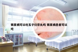 銀屑病可以吃五子衍宗丸嗎 銀屑病患者可以吃