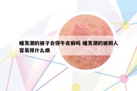 睡發(fā)潮的被子會(huì)得牛皮癬嗎 睡發(fā)潮的被褥人容易得什么病