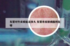 東營對牛皮癬能活多久 東營市皮膚病醫(yī)院在哪