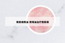 銀屑病焦油 焦煤油治療銀屑病