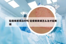 輕度銀屑病治好嗎 輕度銀屑病怎么治才能斷根