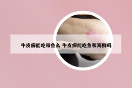 牛皮癬能吃帶魚么 牛皮癬能吃魚和海鮮嗎