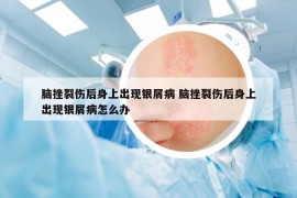 腦挫裂傷后身上出現(xiàn)銀屑病 腦挫裂傷后身上出現(xiàn)銀屑病怎么辦