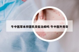 牛中醫(yī)草本抑菌乳膏能治癬嗎 牛中醫(yī)外用膏