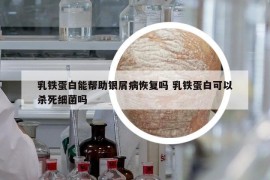 乳鐵蛋白能幫助銀屑病恢復(fù)嗎 乳鐵蛋白可以殺死細(xì)菌嗎