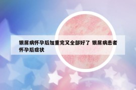 銀屑病懷孕后加重完又全部好了 銀屑病患者懷孕后癥狀