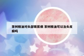 茶樹(shù)精油對(duì)頭部銀屑病 茶樹(shù)精油可以治頭皮癬嗎