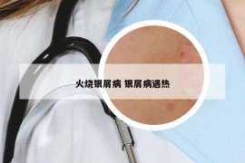 火燒銀屑病 銀屑病遇熱